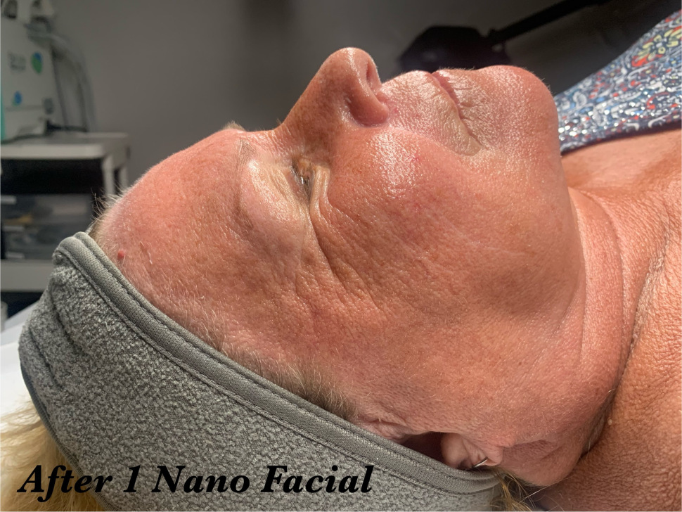 Post-treatment nano infusion with dermaplaning session — plumper, brighter skin