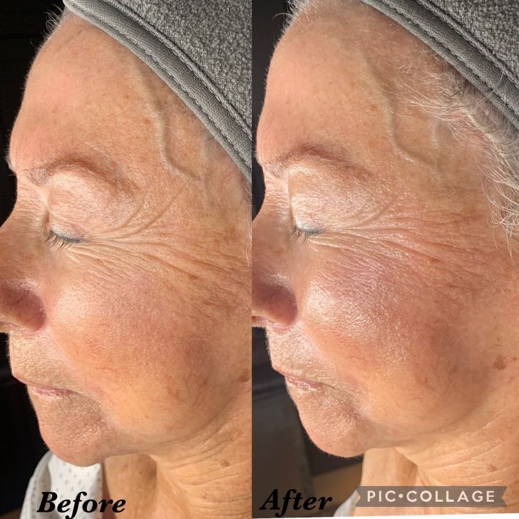 Before and after results showing softened deep set lines after nano infusion facial plus dermaplaning