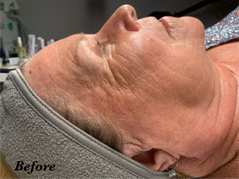 Client skin before third nano infusion and dermplaning — visible lines and dullness