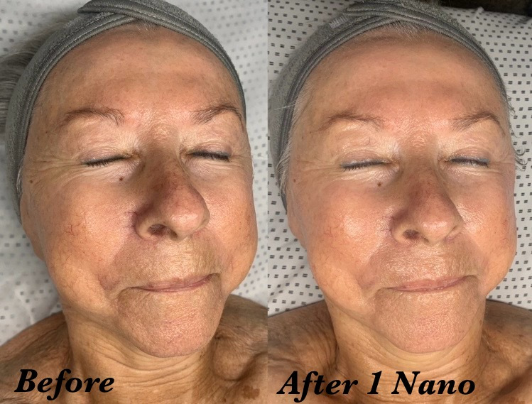 Visible results after one nano infusion facial session — smoother, more hydrated skin