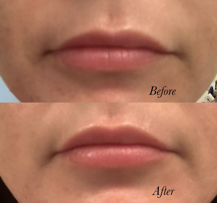 Before and after Lip Nano Infusion showing smoother, fuller, and more hydrated lips with no needles