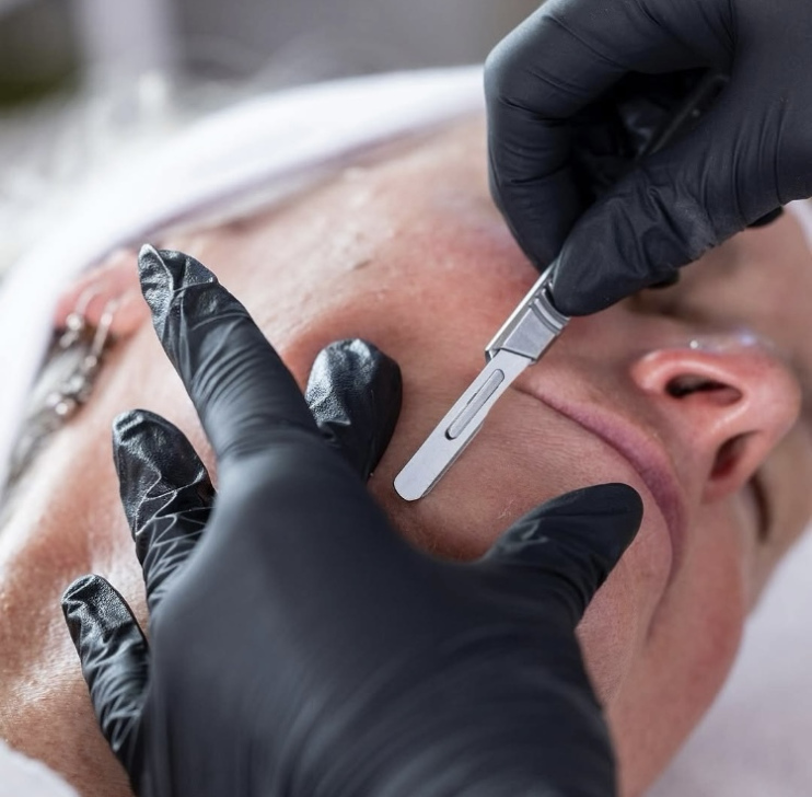 Dermaplaning facial in progress at Roses & Wallflowers Esthetics to exfoliate and smooth the skin