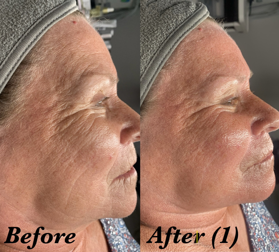 Client skin before third nano infusion treatment — visible lines and dullness