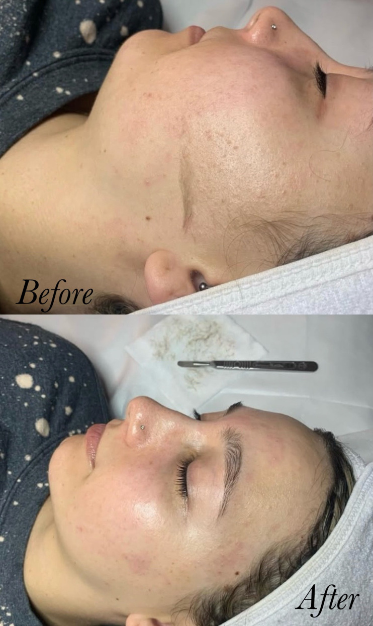 Dermaplaning facial with enzyme peel and red light therapy at Roses & Wallflowers Esthetics in Ormond Beach
