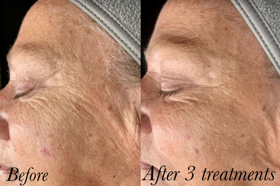 Client skin before first nano infusion facial treatment at Roses & Wallflowers Esthetics